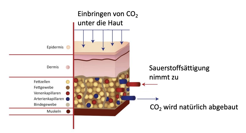 Die lokale Sauerstoffversorgung des Gewebes wird durch Einbringung von CO2 besser (Bohr-Effekt).